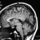 Brain  Thick Corpus Callosum Variant (10)