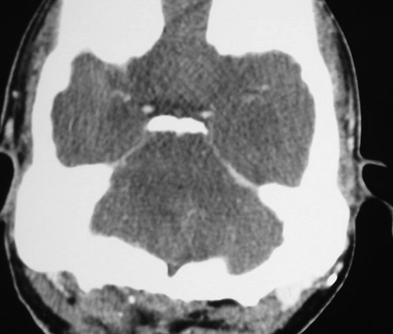 Brain  Air Bobble And Cerebellar Lesion After Craniotomy, Osteopetrosis (6)