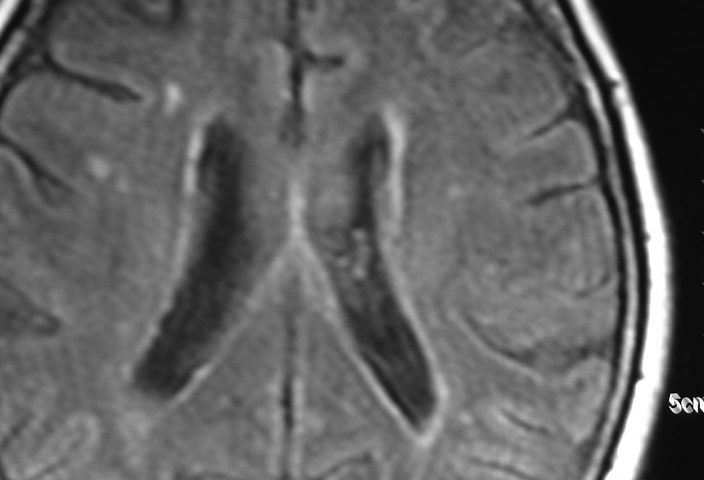 Brain  Cavernomatosis (11)