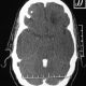 Brain  Left Frontal Tumor (2)