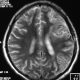 ENT  Sphenoidal Sinus Mucocele Or Petechial Hemorrhage In Brain, Left Temporal Bone Fracture (6)