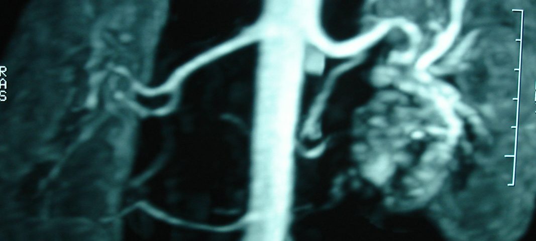 Abdomen  Left Kidney Vascular Anomaly (12)