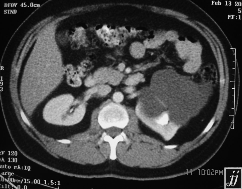 Abdomen  Cystic Tumor Of Kidney (2)