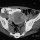 Abdomen  Hematoma Or Clot From Tumor In Urinary Bladder (4)
