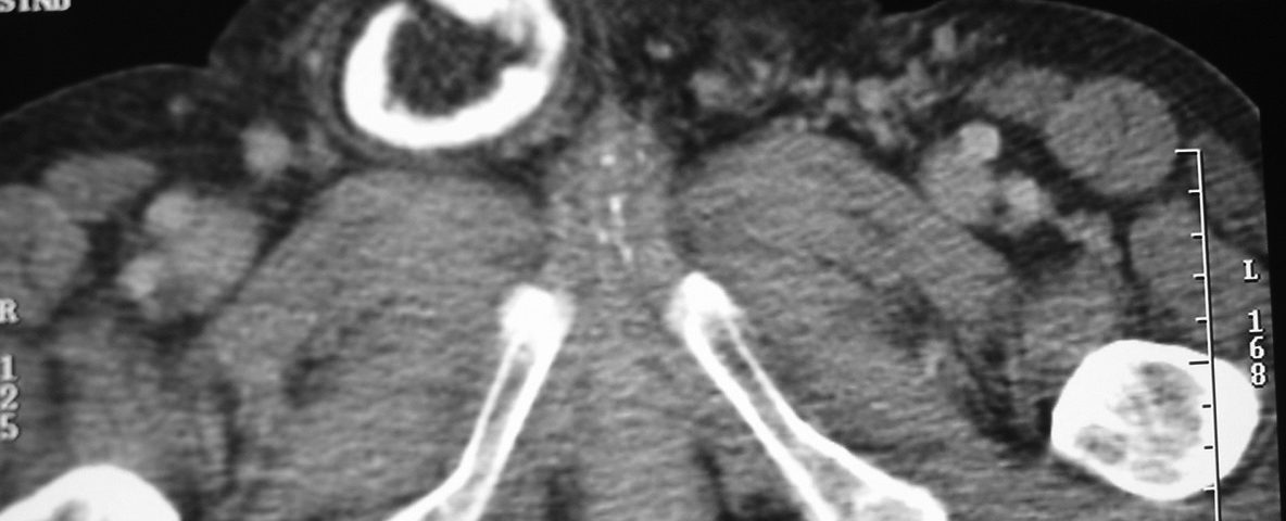 Abdomen  Inguinal Hernia Containing Bowel Loop