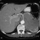 Abdomen  Left Kidney Or Adrenal Tumor (4)