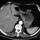 Abdomen  Metastatic Liver (1)