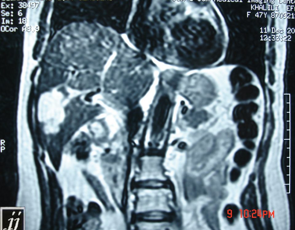 Abdomen  Right Liver Lobe Hemangioma (40)