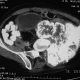 Abdomen  Right Para Spinal Calcified Tumor, Osteosarcoma (10)