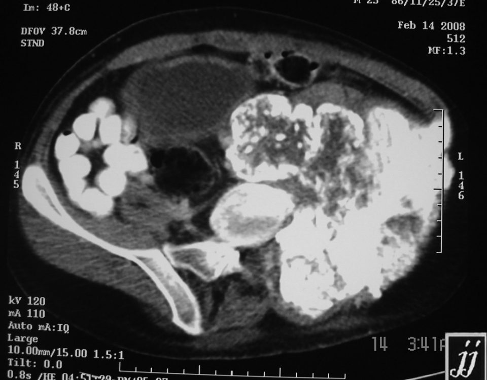 Abdomen  Right Para Spinal Calcified Tumor, Osteosarcoma (10)
