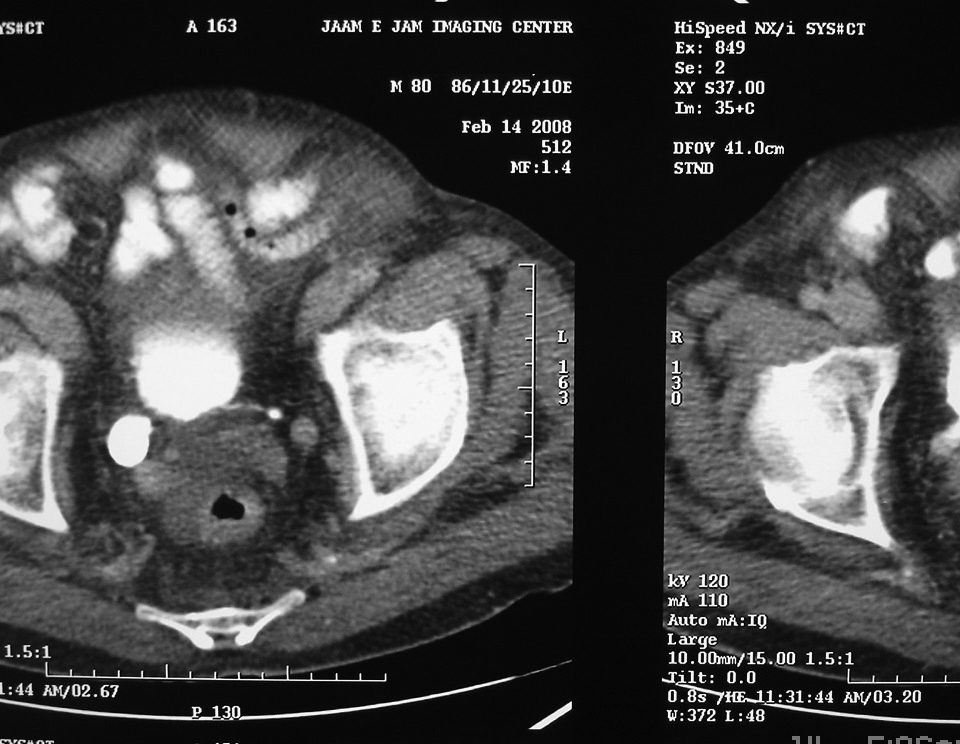Abdomen  Right Side Ureterocele (2)