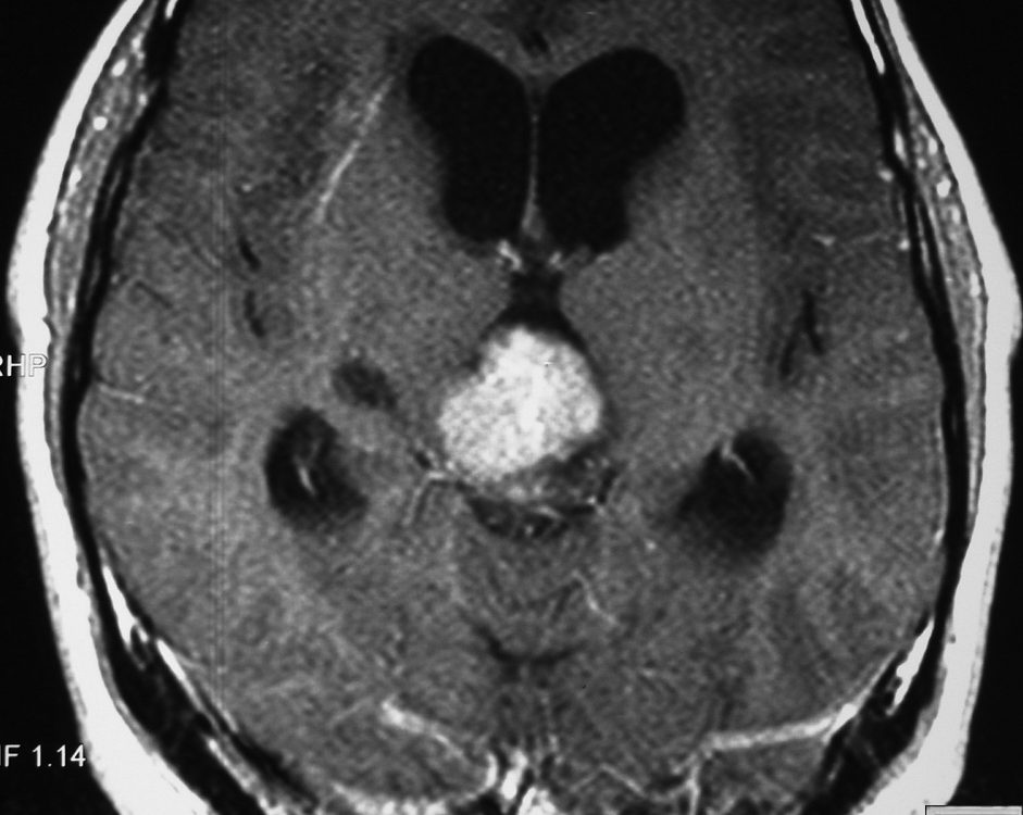 Brain  3rd Ventricle Tumor (1)