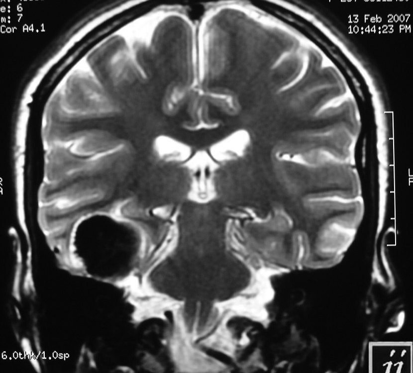 Brain  A Calcified Tumor (6)