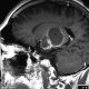 Brain  Astrocytoma (10)