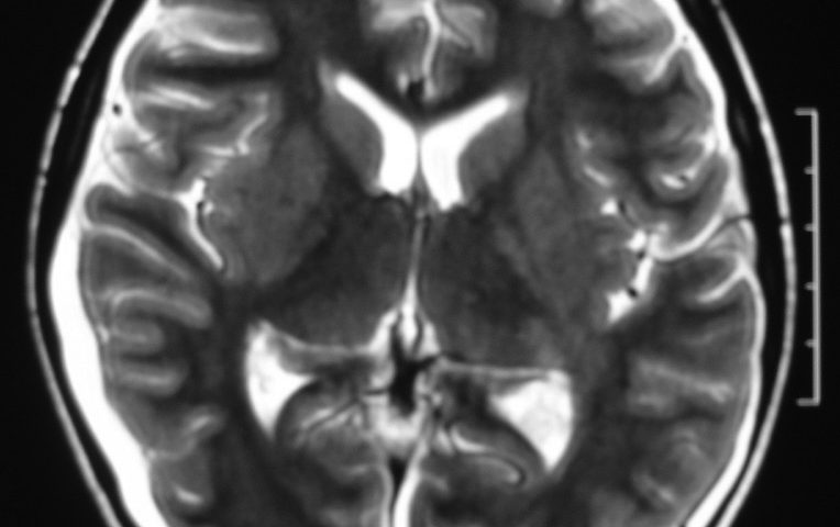 Brain  Bilateral Subdural Hygroma (1)