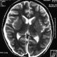 Brain  Bilateral Subdural Hygroma (1)
