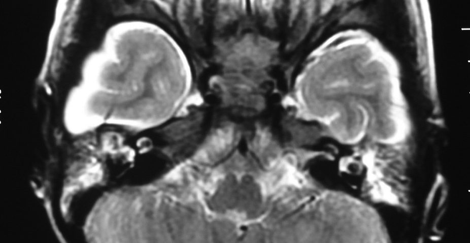 Brain  Bilateral Subdural Hygroma, ITP, Bilateral COM