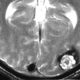 Brain  Cavernous Hemangioma Of Left Occipital Lobe (3)