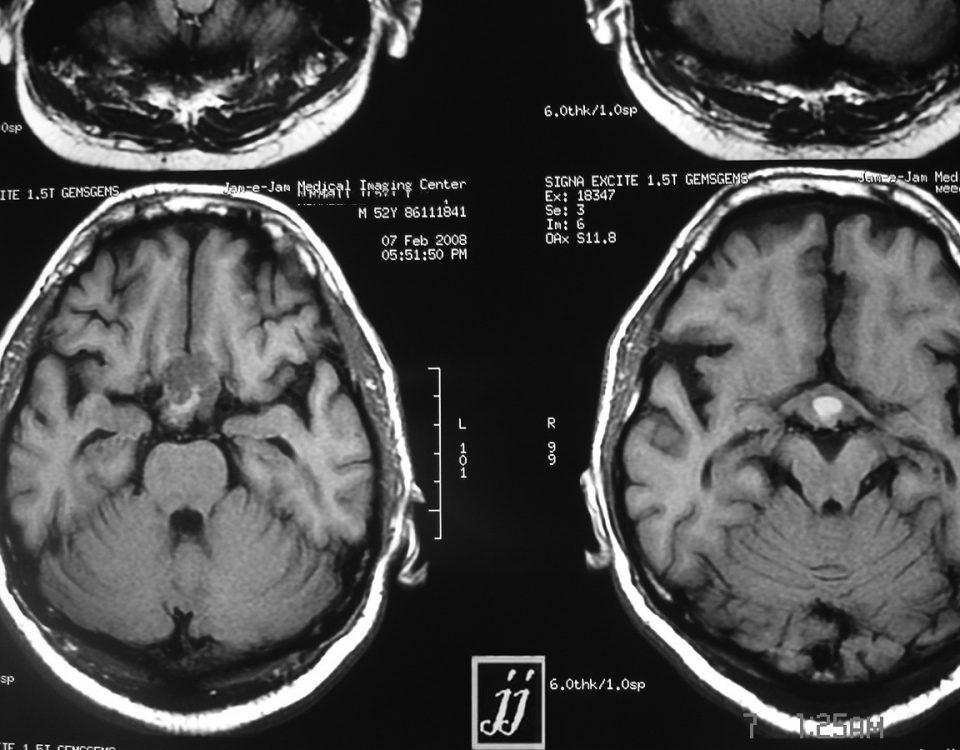 Brain  Craniopharyngioma (2)