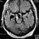 Brain  Craniopharyngioma (9)