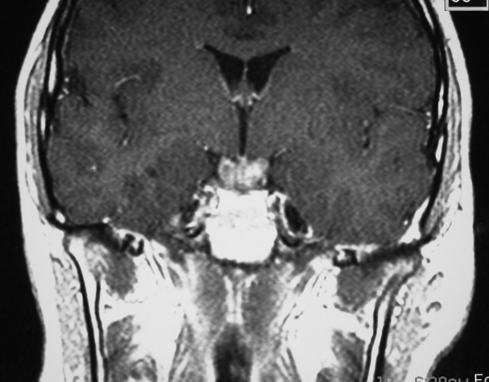 Brain  Suprasellar Tumor, Craniopharyngioma (2)