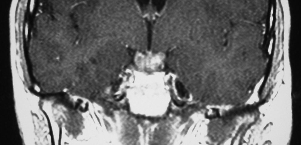 Brain  Suprasellar Tumor, Craniopharyngioma (2)