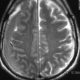 Brain  Bi Lateral Subdural Hematoma (2)