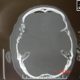 Brain  Craniotomy And Cranio Plasty (2)