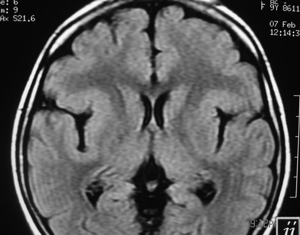 Brain  Ectopic Or Heterotopic Grey Mater Around Sylvian Fisher, Sylvian Syndrome (4)