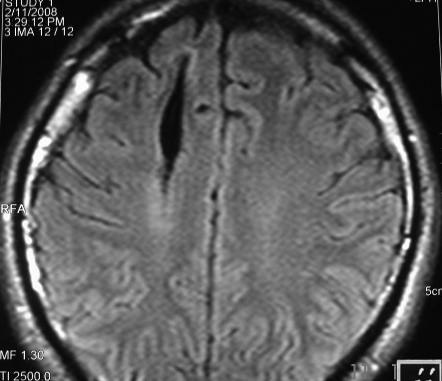 Brain  Interacerebral Hematoma In Shrinkage (4)