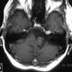 Brain  Vertebral Basilar Aneurism (5)