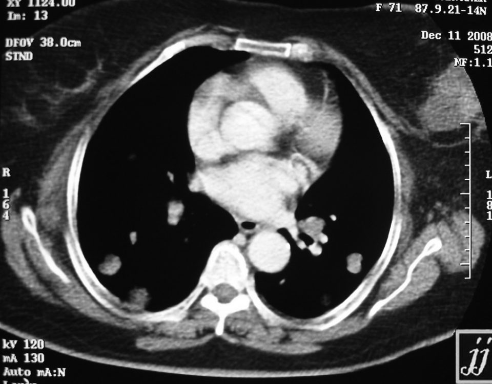 Chest  Lung Metastasis From Left Breast Tumor