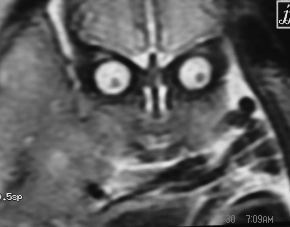Fetus  Fetal Brain MRI (17)