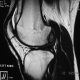 MSK  Loose Body, Dissecting Osteochondritis (4)