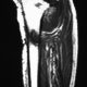 MSK  Tibia Osteosarcoma Above Exostosis (5)