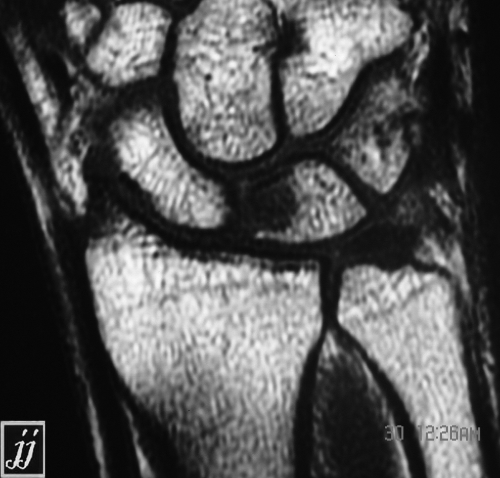 A Cyst In Lunate And Fluid Around Scaphoid Radiopaedia 1736