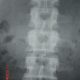 Spine  Antelisthesis Of L5 S1 (2)