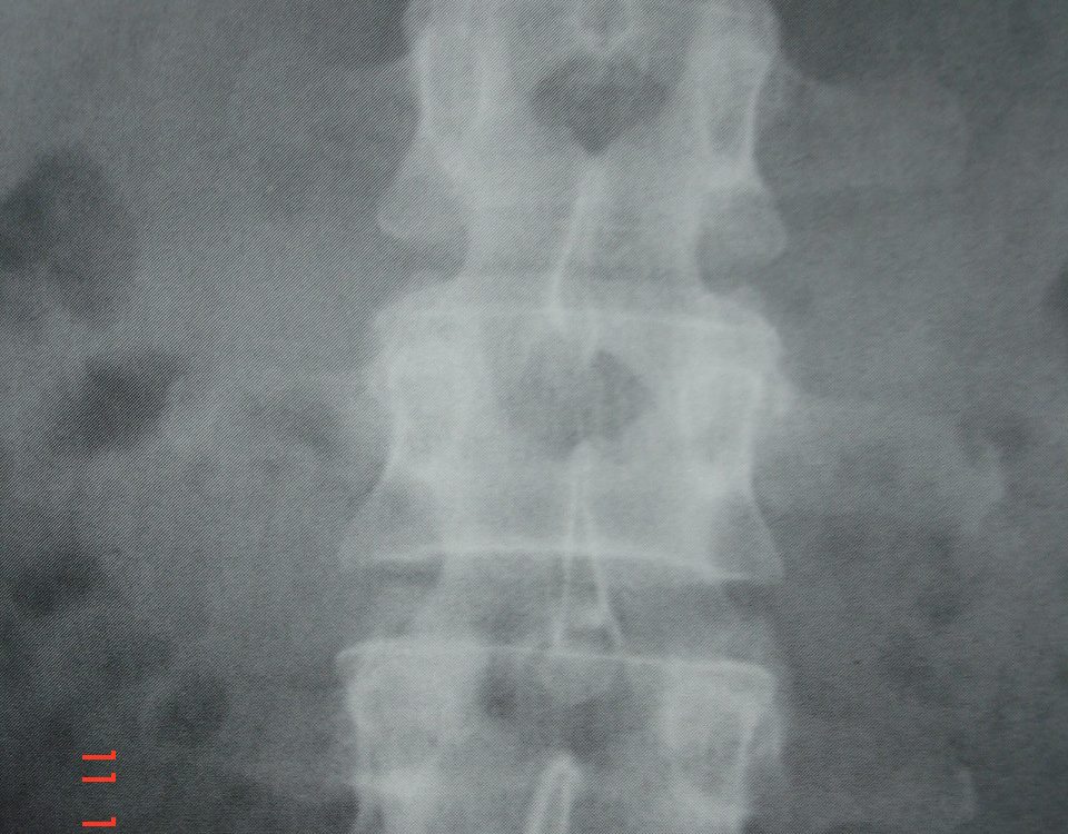 Spine  Antelisthesis Of L5 S1 (2)