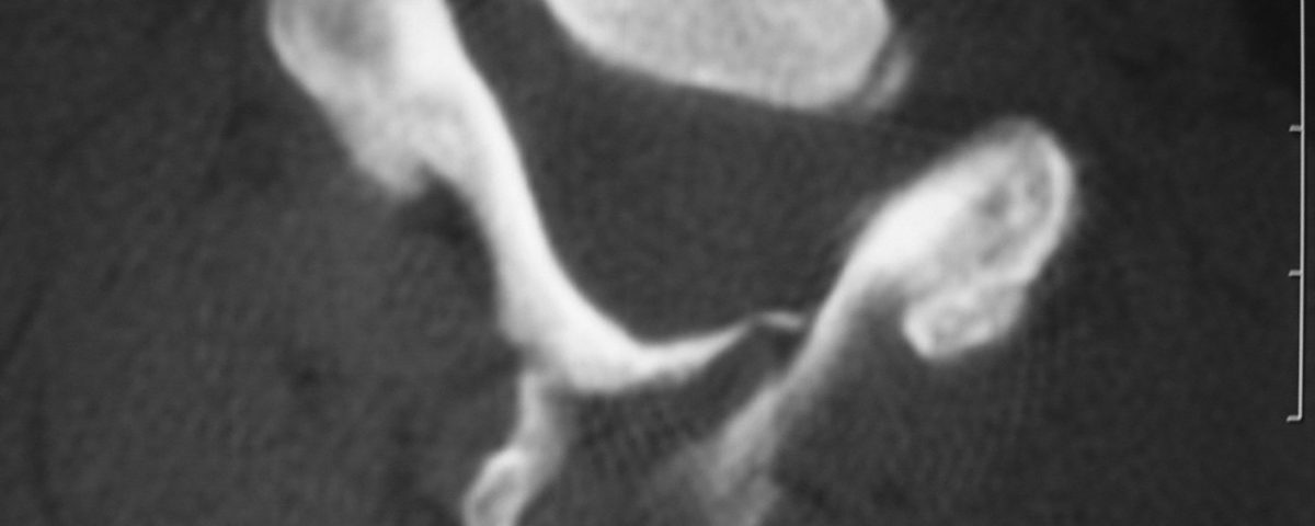 Spine  C2 Arch Fracture (3)
