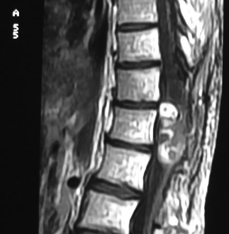 Spine  Conus Medullarise Tumor, Asterocytoma (11)