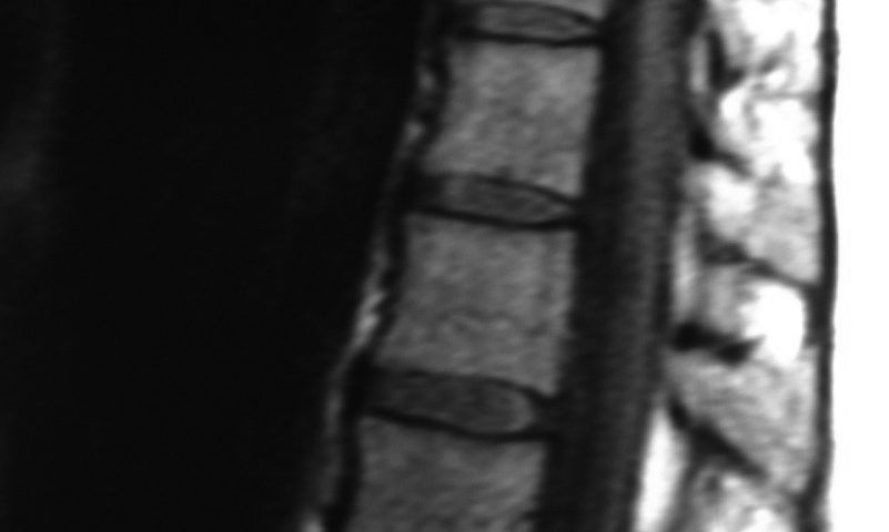 Spine  D10 D11 Facet Enlargement (2)