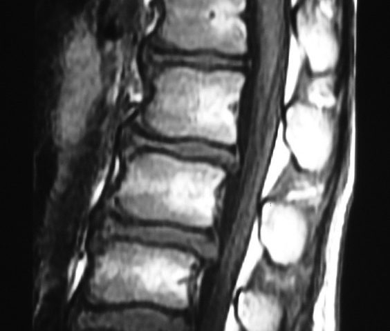 Spine  Multiple Disc Herniation (2)