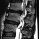 Spine  Cauda Equina Lipoma (2)
