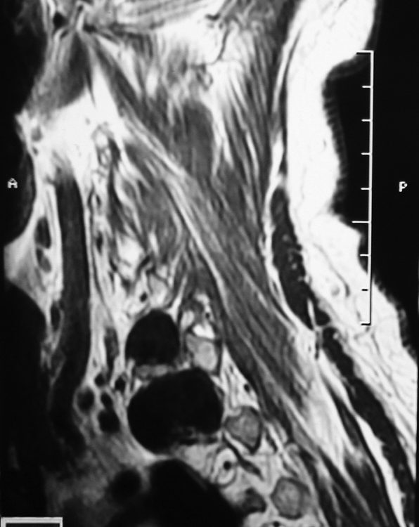 Spine  Foraminal Tumor (6)