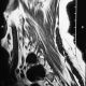 Spine  Foraminal Tumor (6)