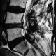 Spine  Lumbar Scar Tissue (3)