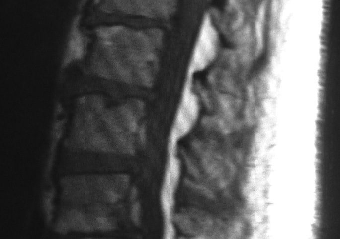 Spine  Multiple Disc Herniation But DDX With Tumor At L3 L4 Extrusion (2)