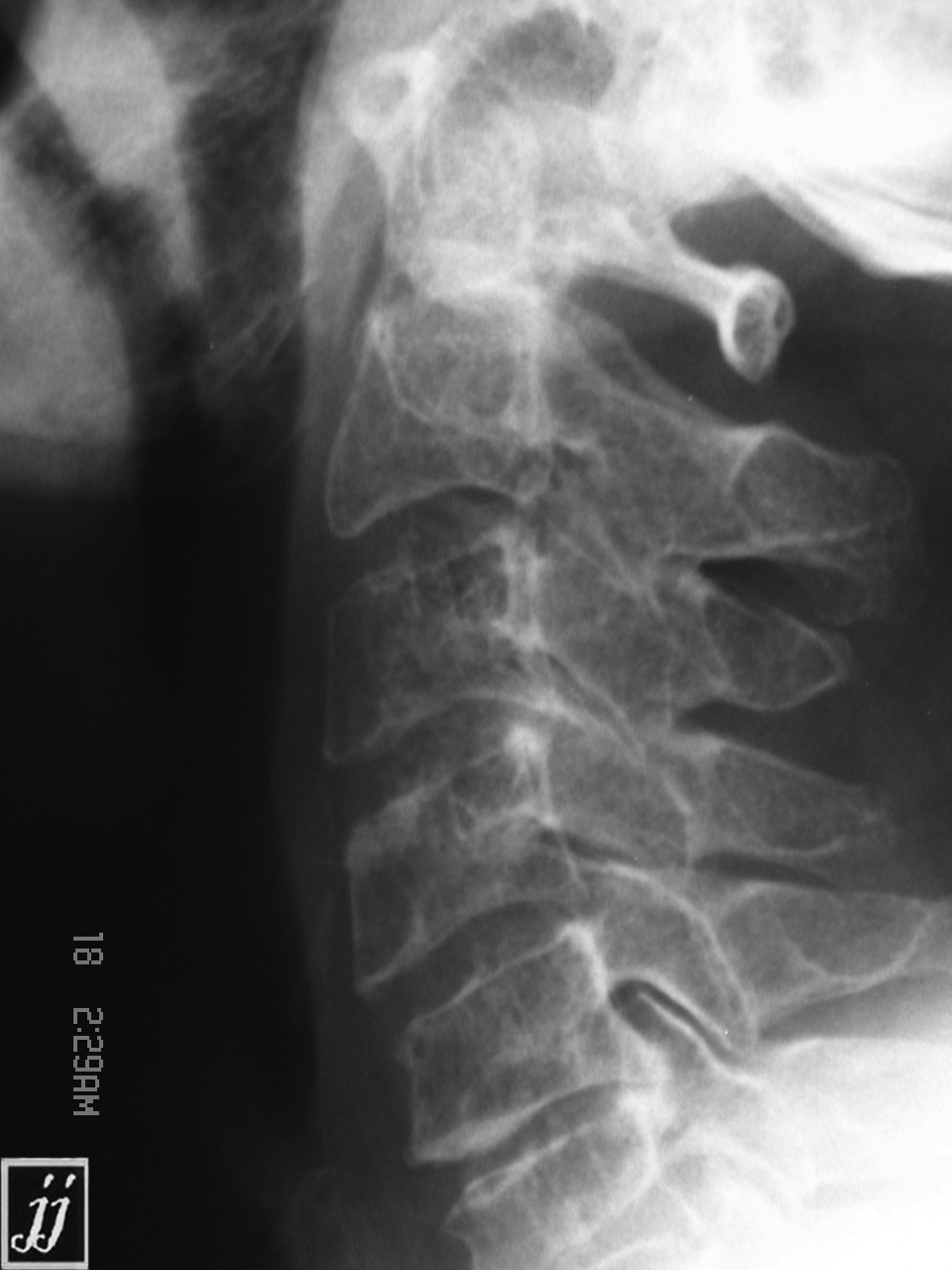 Multiple Myeloma Radiopaedia 