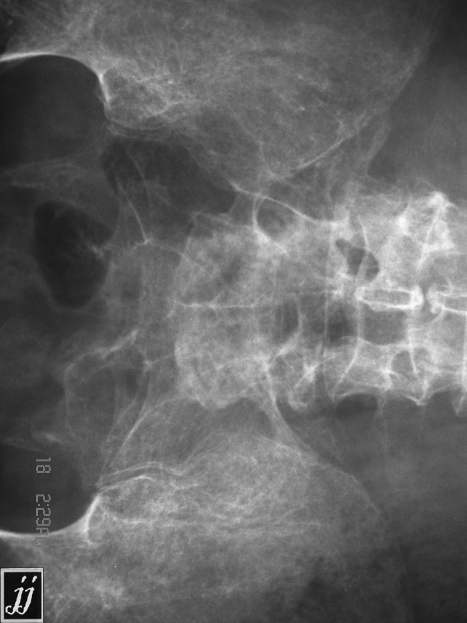 Multiple Myeloma Radiopaedia 