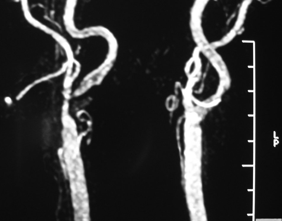 Vascular  Narrow Origin Of Right Internal Carotid Artery (2)